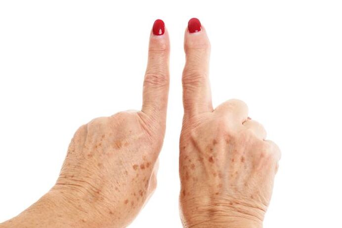 deformed arthrosis in the fingers