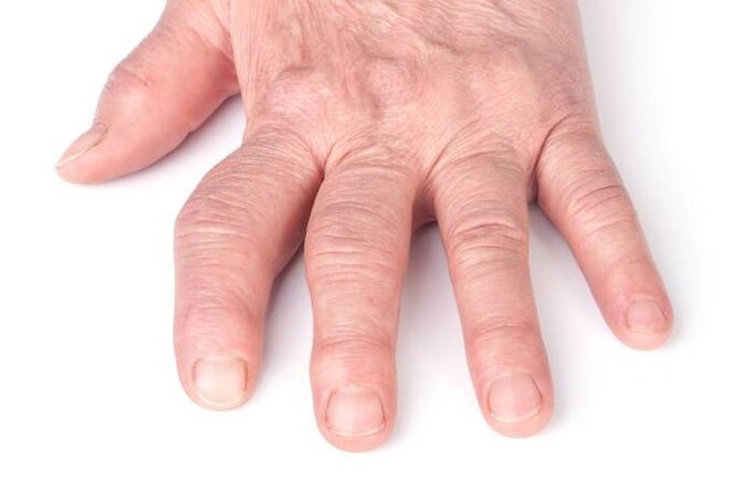 deformed arthrosis in the hand