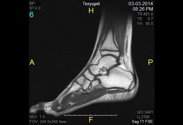 pictures of the ankle for arthrosis