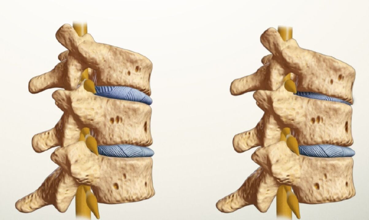 healthy and sore spine with lumbar osteochondrosis