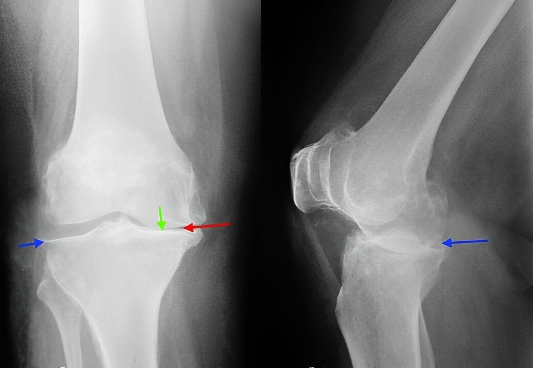 x-ray arthrosis of the knee joint