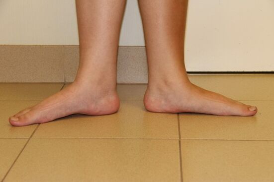Sometimes the source of neck arthrosis is a flat leg