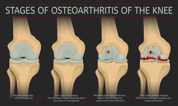 the development of joint arthrosis