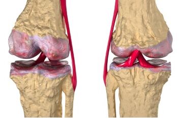 Varicose veins are the cause of the development of gonarthrosis