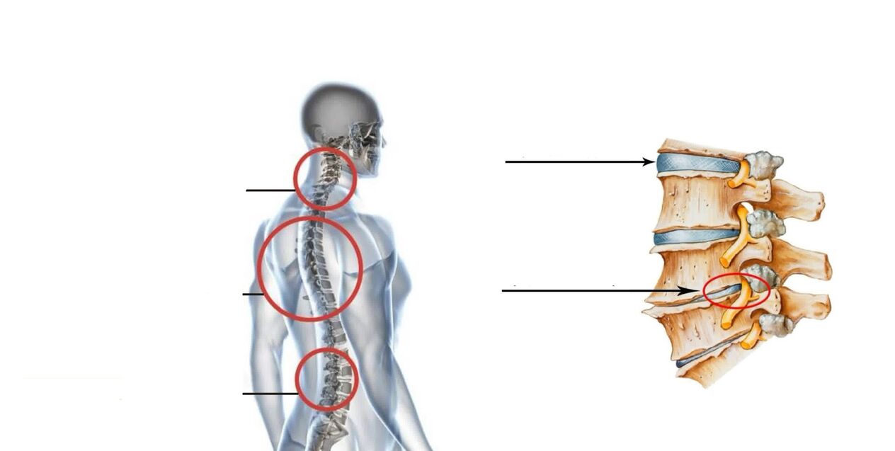 spinal ostechondrosis