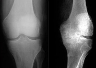 The methods for early diagnosis of osteoarthritis