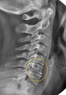Narrowing of the intervertebral space on x-rays