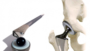 hip joint endoprosthetics for arthrosis