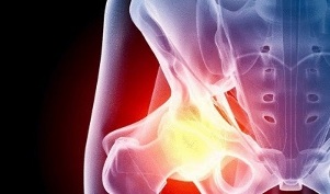 reasons for the development of hip arthrosis