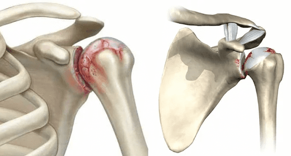 what is arthrosis of the shoulder joint
