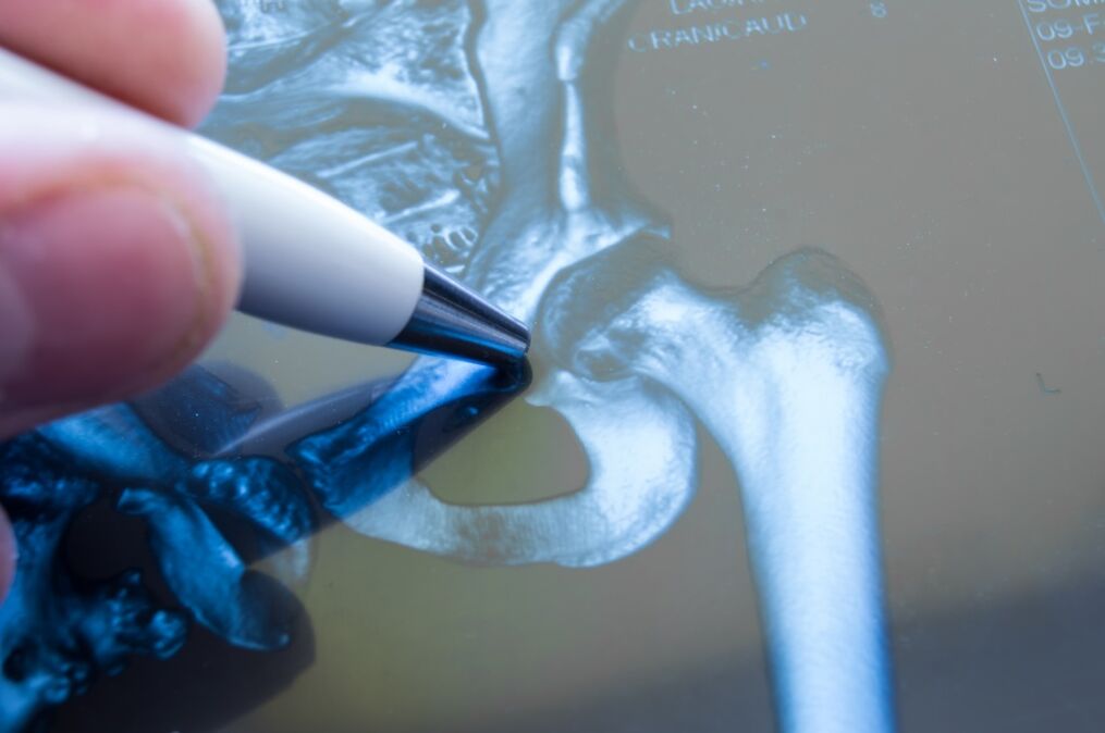 Arthrosis of the hip joint on radiography