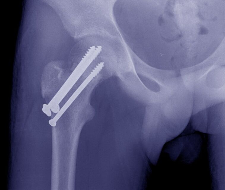 X-ray of hip joint, fracture osteosynthesis with internal fixation device