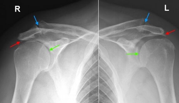 X-ray of the shoulder joint